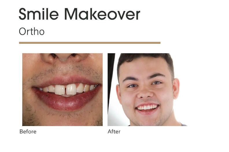 Smile Makeover Ortho Before and After