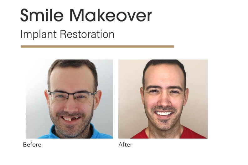 Smile Makeover Implant Restoration Before and After