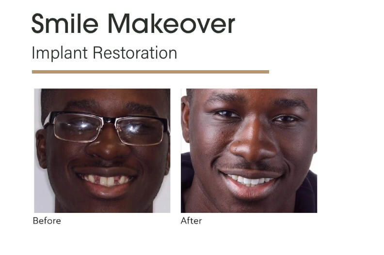 Smile Makeover Implant Restoration Before and After