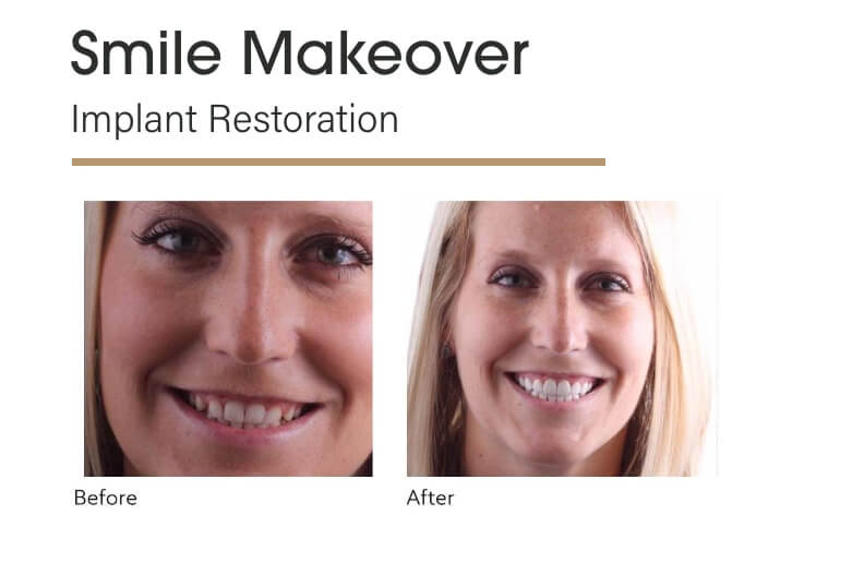 Smile Makeover Implant Restoration Before and After