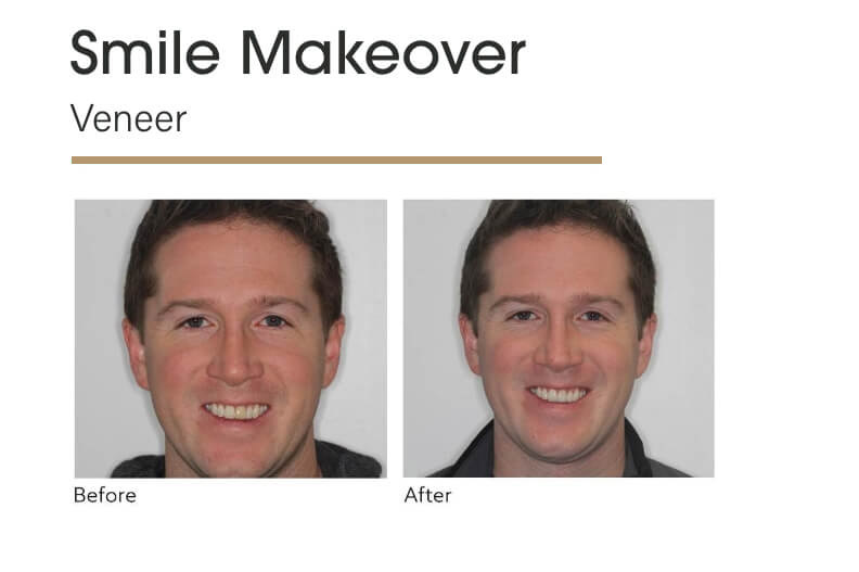 Smile Makeover Veneer Before and After